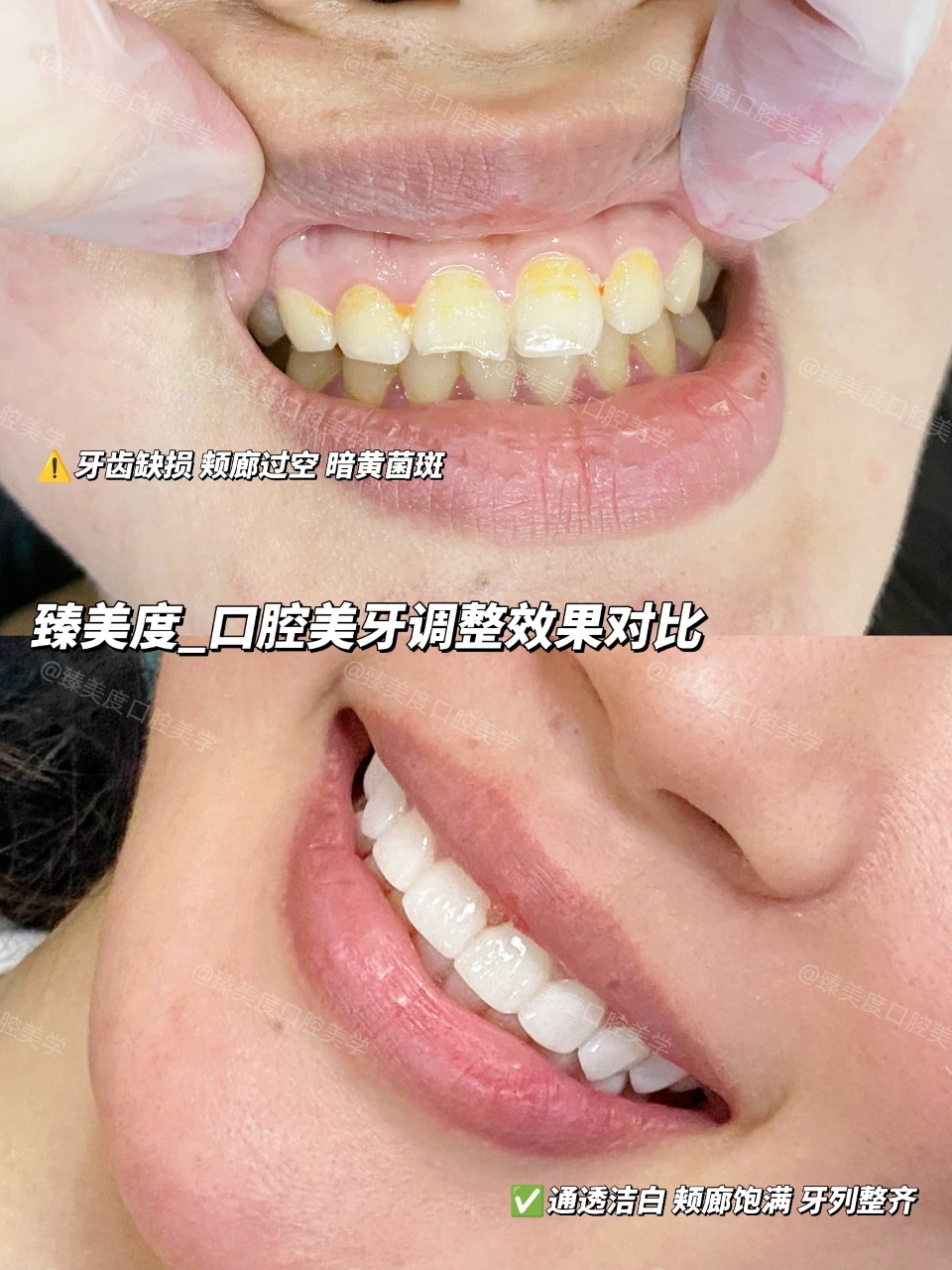 shanghai-veneers-smile-design