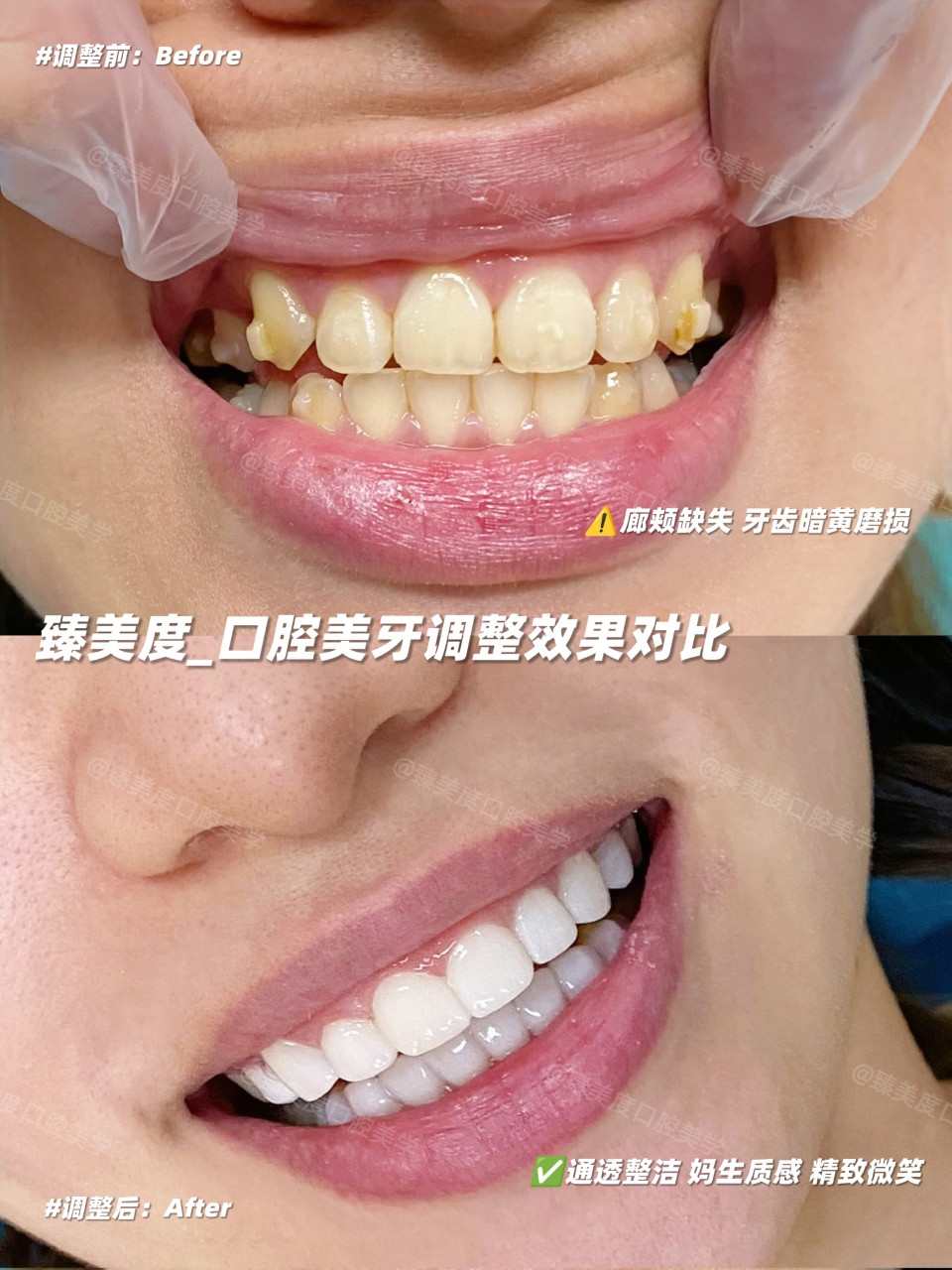 色阶与笑线参考