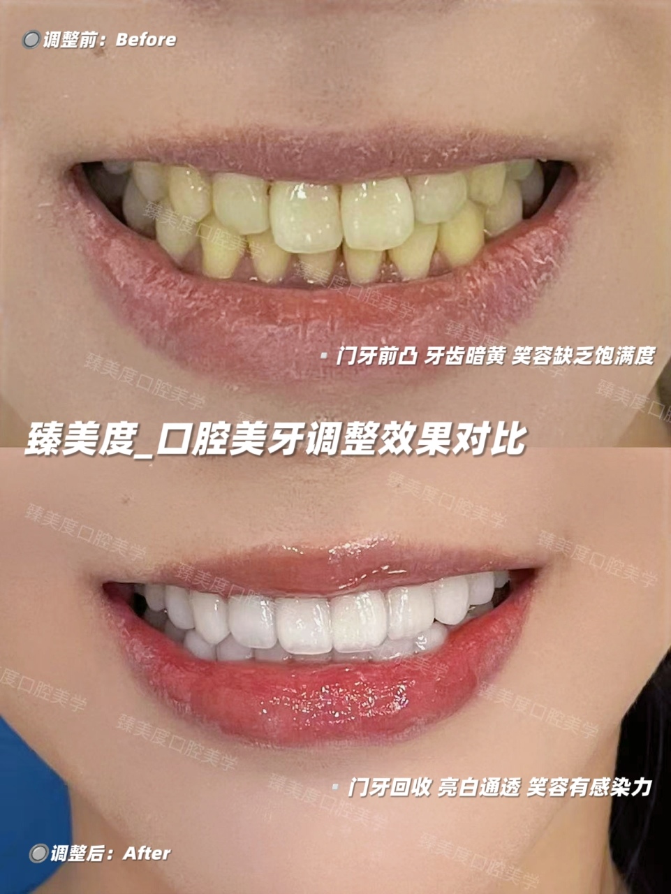 8 颗贴面微笑改造
