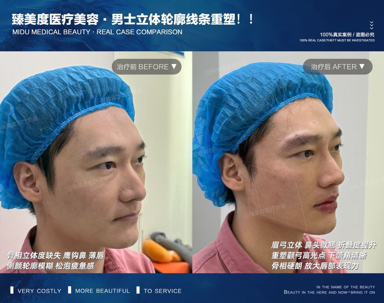 guangzhou-rhinoplasty-combo
